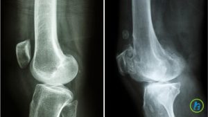 Osteoartrita