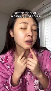 Clear Skin Journey with OOTD BEAUTY ✨