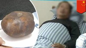 화장실도 안가고 밤새서 마작만 하던 남성, 거대한 방광결석 때문에 병원행