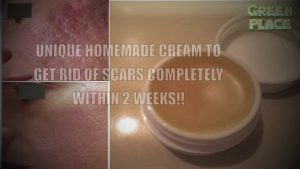 UNIQUE HOMEMADE CREAM TO GET RID OF SCARS COMPLETELY WITHIN 2 WEEKS!!